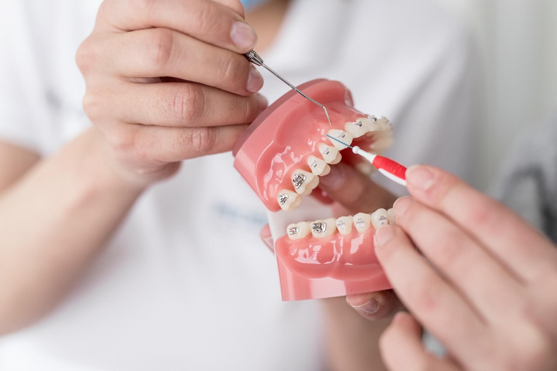 Tut Es Weh Eine Feste Zahnspange Zu Entfernen Feste Zahnspangen - Federleicht Kieferorthopädie Hannover